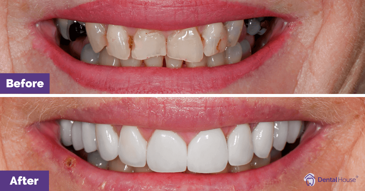 Porcelain-Veneers-Dental-Crown-in-DHG-2