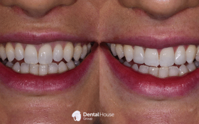Conservative Dental Treatment Clinical Case in Gisborne