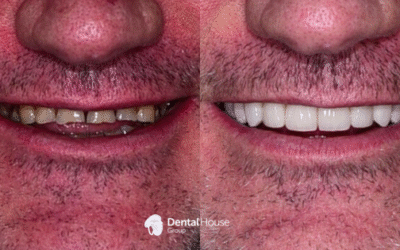 Conservative Reconstruction Clinical Case in Gisborne