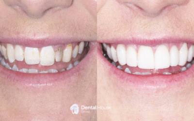 Conservative Restorative Treatment Clinical Case in Gisborne