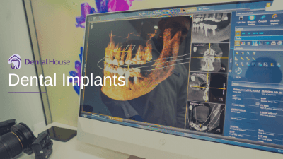 Dental Implants