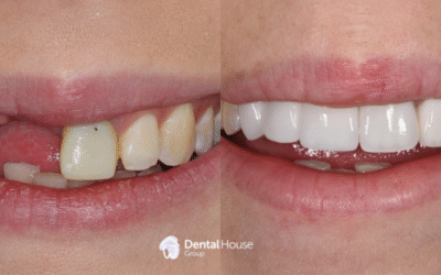 Conservative Implant Restoration Clinical Case in Gisborne