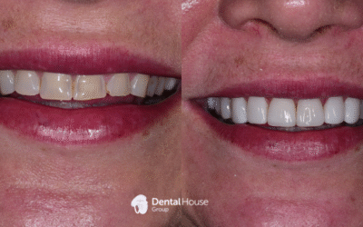 Composite Veneers & Whitening Case Study in Sunbury