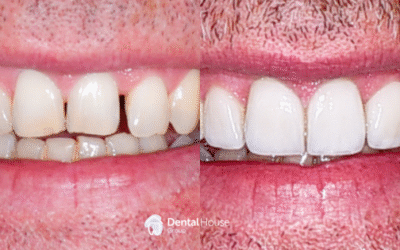 Invisalign & Veneers Case Study in Bacchus Marsh