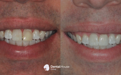 Porcelain Crown Discoloured Tooth Case Study in Sunbury
