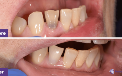 Internal Bleaching Root Canal Tooth Case