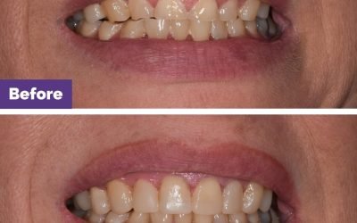 Composite Veneers Tooth Proportion Case