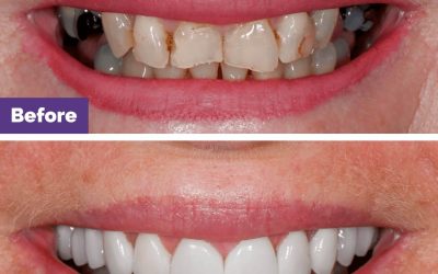 Combined Veneers & Crowns Case Study