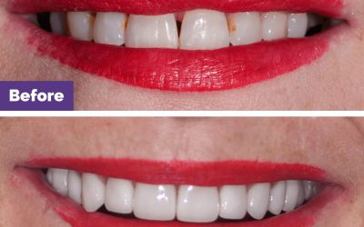 Combined Veneers & Implants Case Study