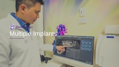 Multiple Implants