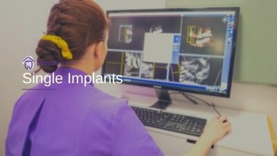 Single Implants