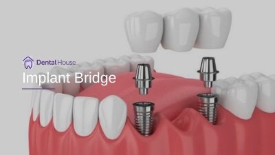 Implant Bridge