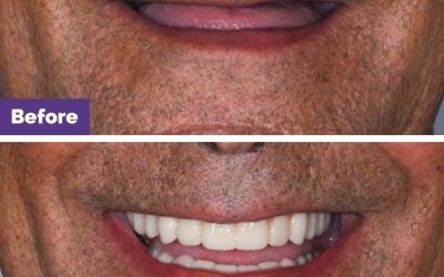 Implant-Supported Denture Case Study