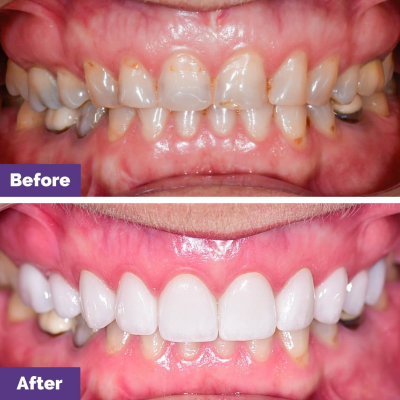 Porcelain Veneers Multiple Concerns Case