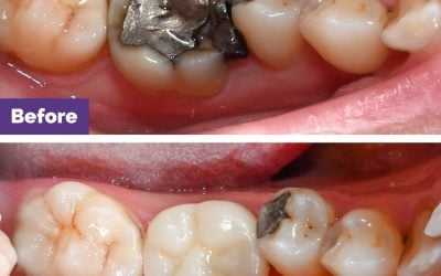 CEREC Same-Day Crown Case Study