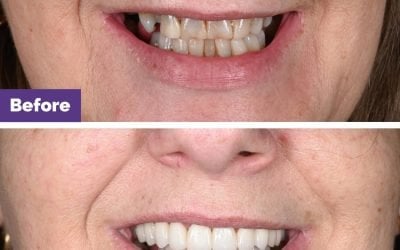 Porcelain Bridge & Veneers Gap Closure Case