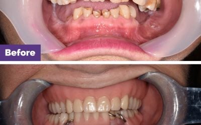 Complete Dentures Case Study