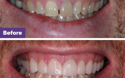 Combined Crowns & Veneers Cracked Teeth Case