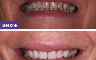 Porcelain Veneer Longevity Case Study