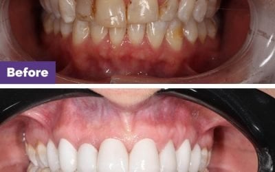 Invisalign Gap Closure Case Study