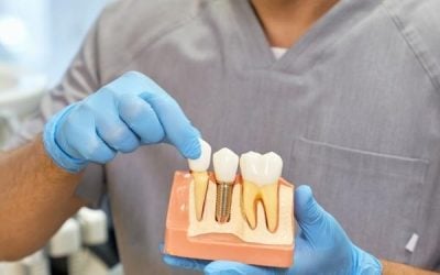 How Much Does a Dental Implant Cost in Gisborne VIC? What Affects the Investment