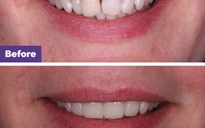 Veneers & Crowns Short Teeth Case Study