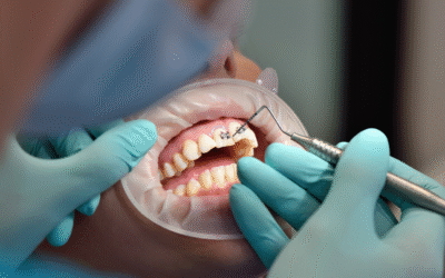 Sleep Dentistry for Gag Reflex: When Your mouth Won’t Cooperate