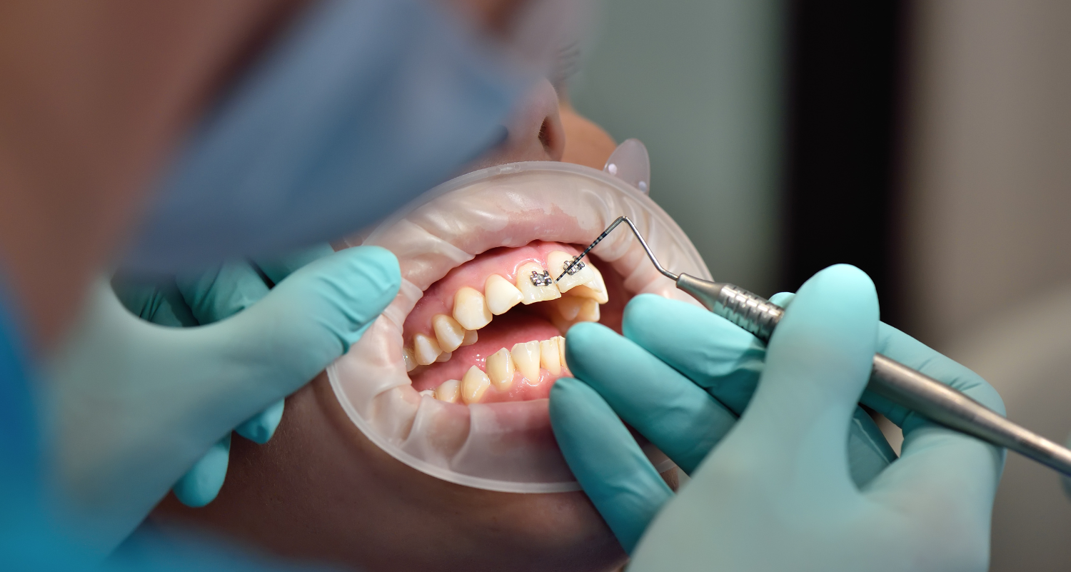 Sleep Dentistry for Gag Reflex: When Your mouth Won't Cooperate New Gisborne Melbourne Dentists