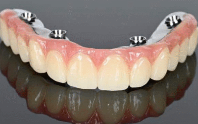 Can You Get Both Upper and Lower All-On-4 Plus® on the Same Day?