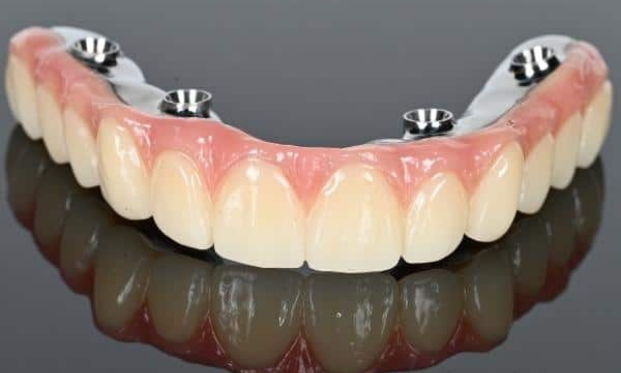 Can You Get Both Upper and Lower All-On-4 Plus® on the Same Day in Gisborne Dental House