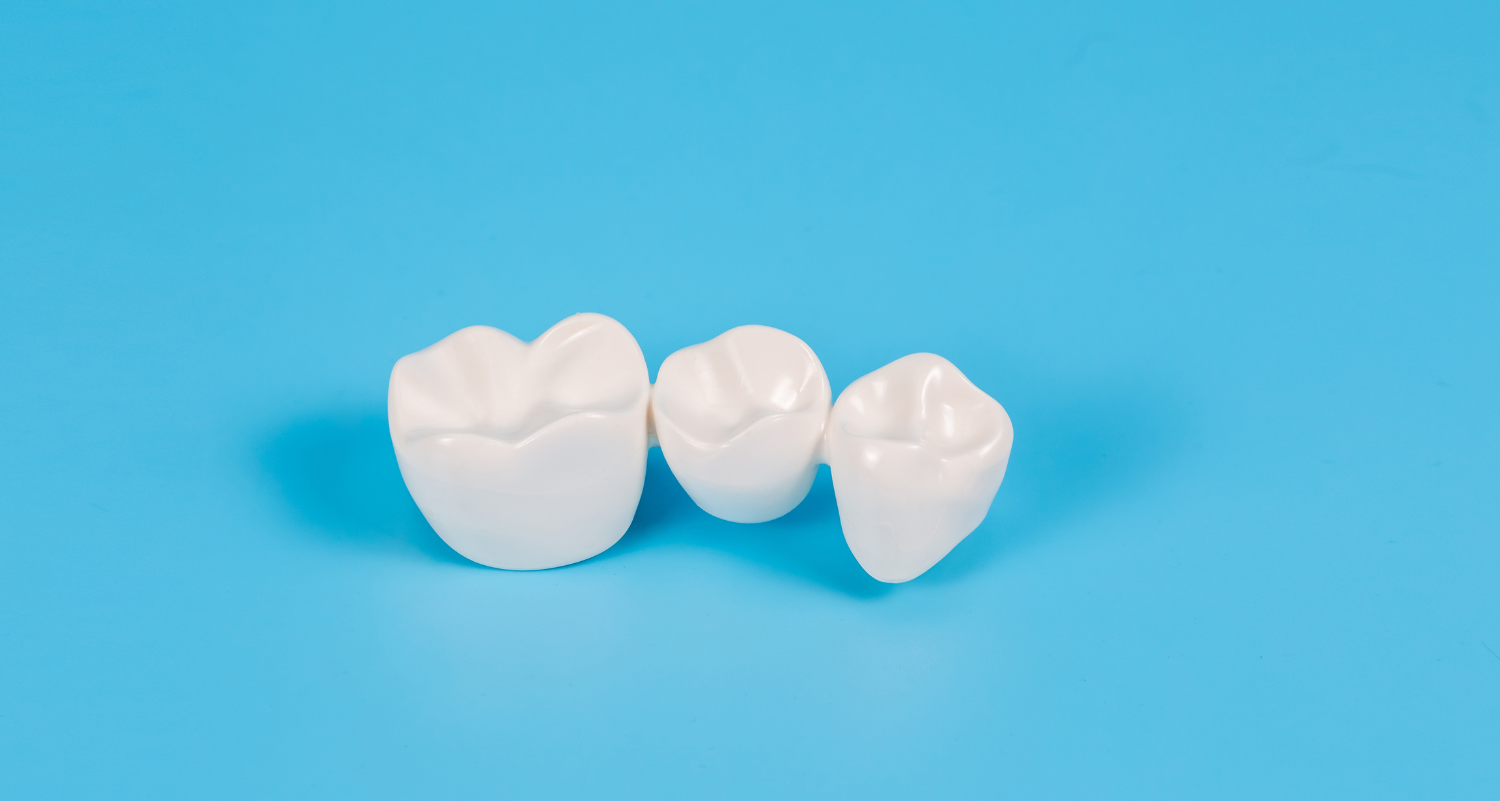 How CEREC Eliminates the Guesswork from Crown Fitting in Gisborne Dental House