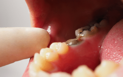 When Fillings Aren’t Enough: The Complete Decay Restoration Guide