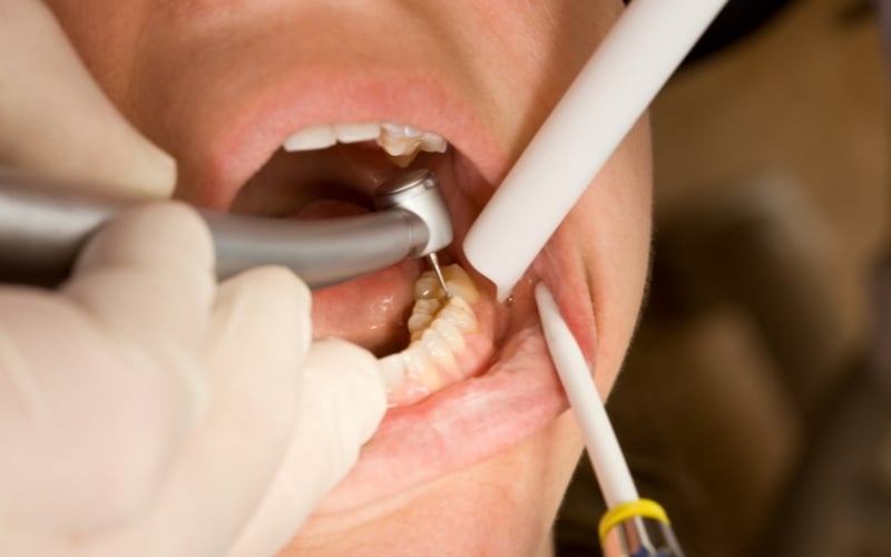 How Long Will Your Filling Last The Honest Answer in Gisborne Dental House