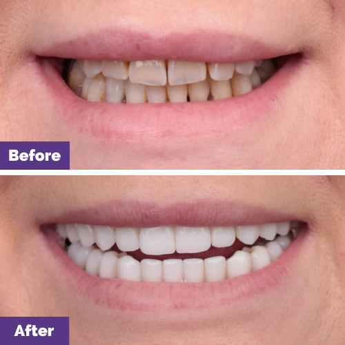 Kath's Upper and Lower All-On-4 Plus Smile Makeover in Dental House