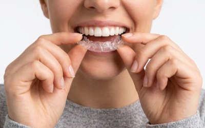 Clear Aligners vs Metal Brackets: Which Treatment Wins for Crowded Teeth?