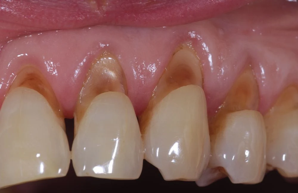 Abfraction Abfraction Lesions What Are They