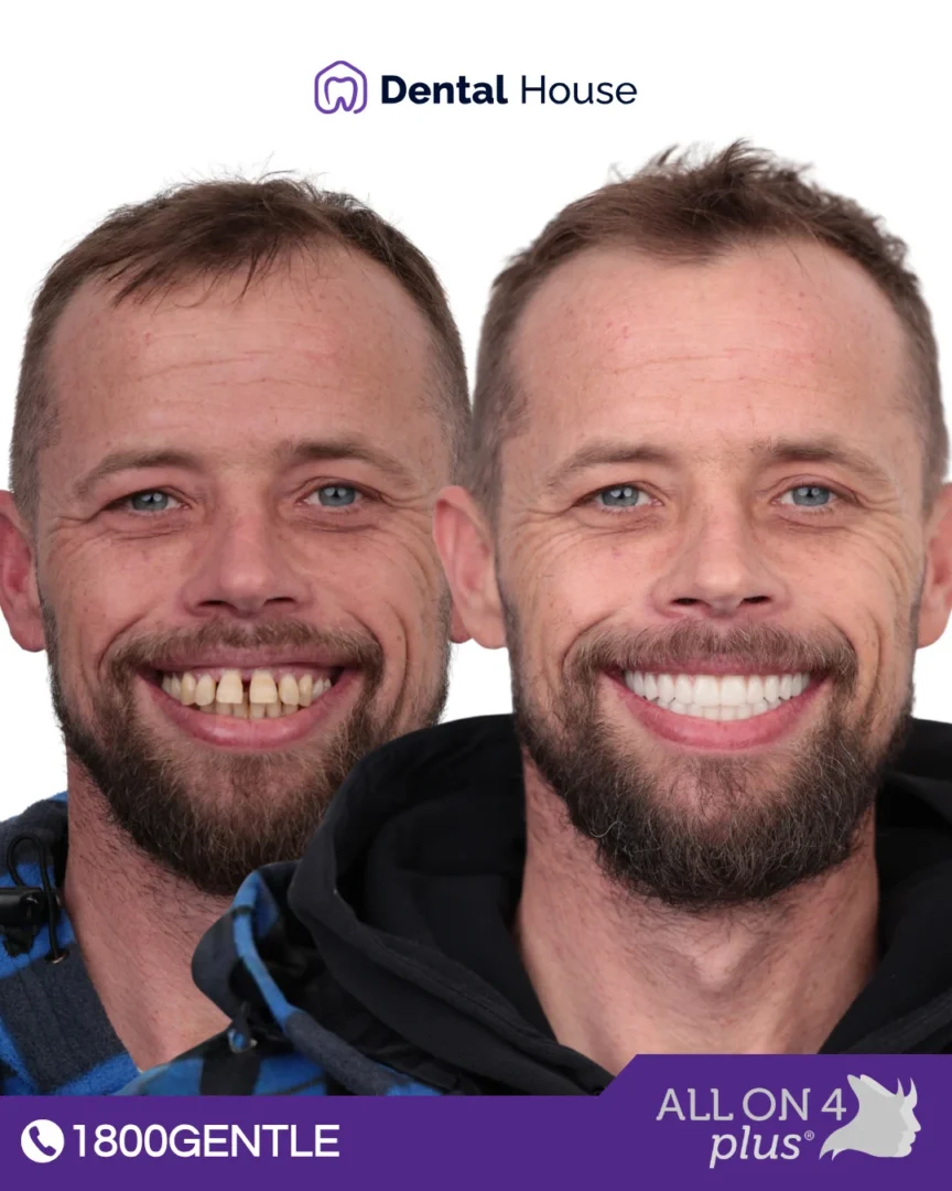 All-On-4 Plus®