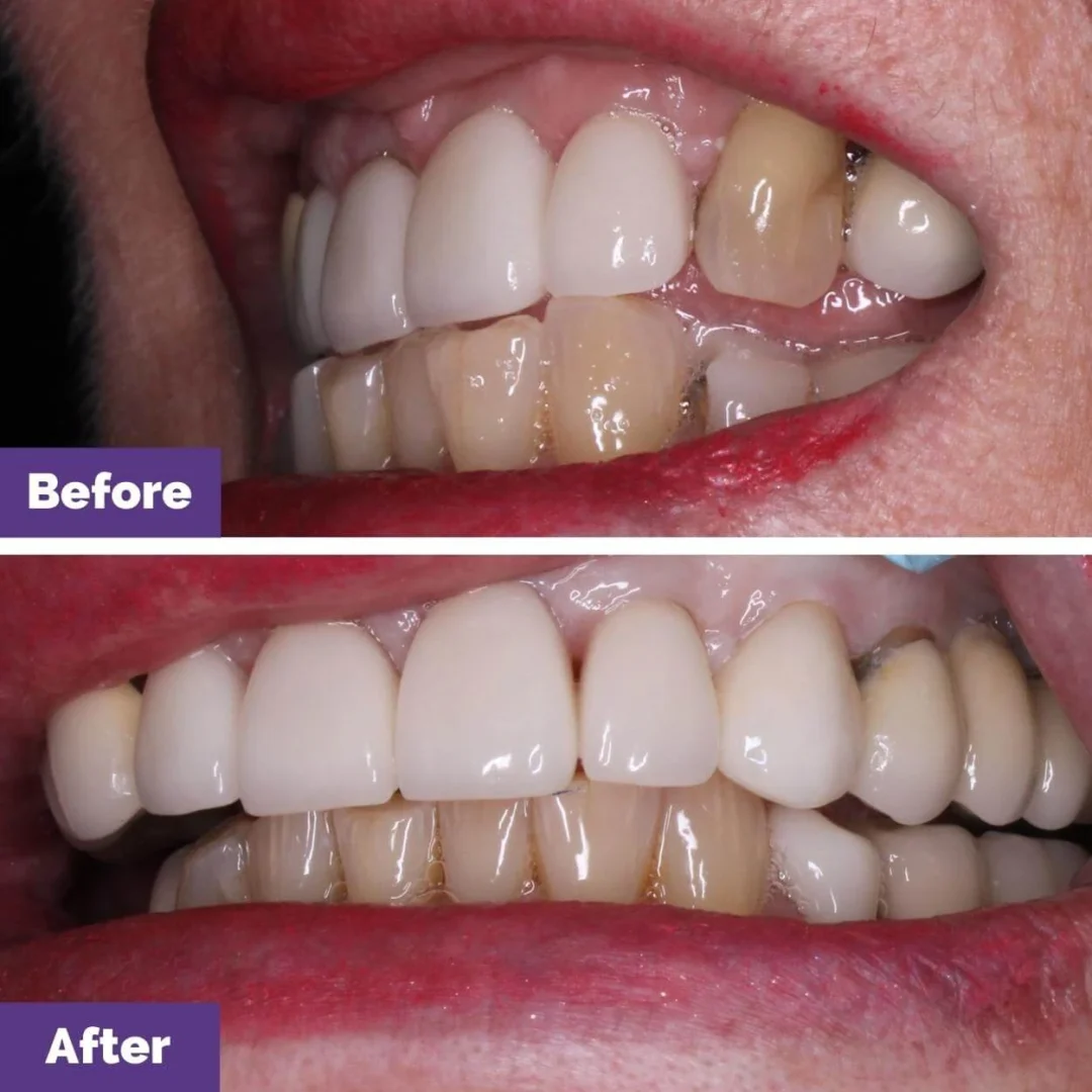 AllOn Plus Full Arch Case Study