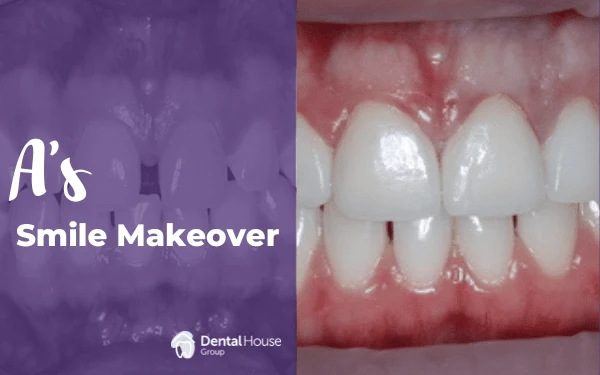 As Smile Makeover in Melbourne