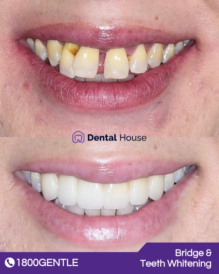 Bridge &# Teeth Whitening