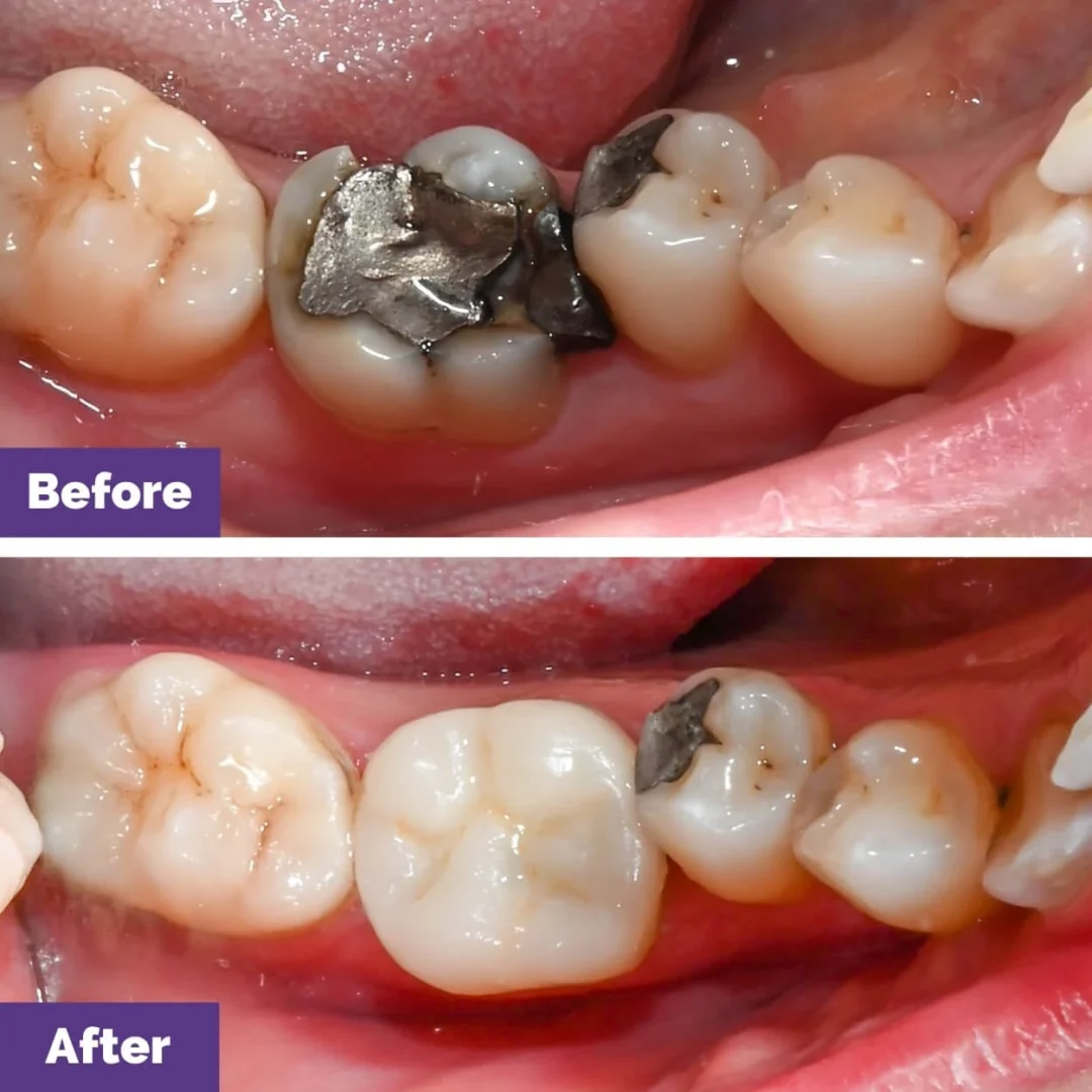 CEREC SameDay Crown Case Study