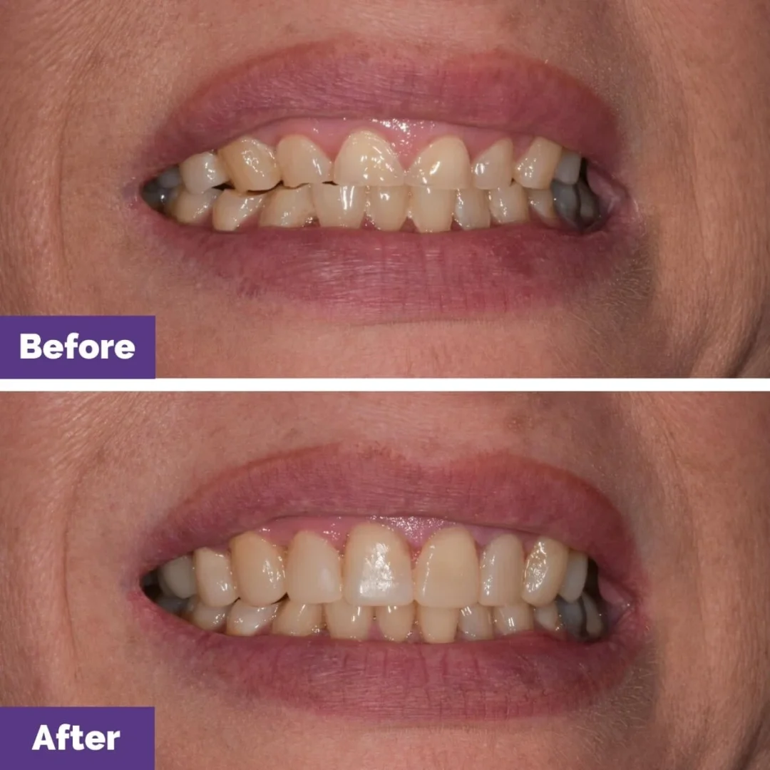 Can Composite Veneers Improve Tooth Proportion in Gisborne