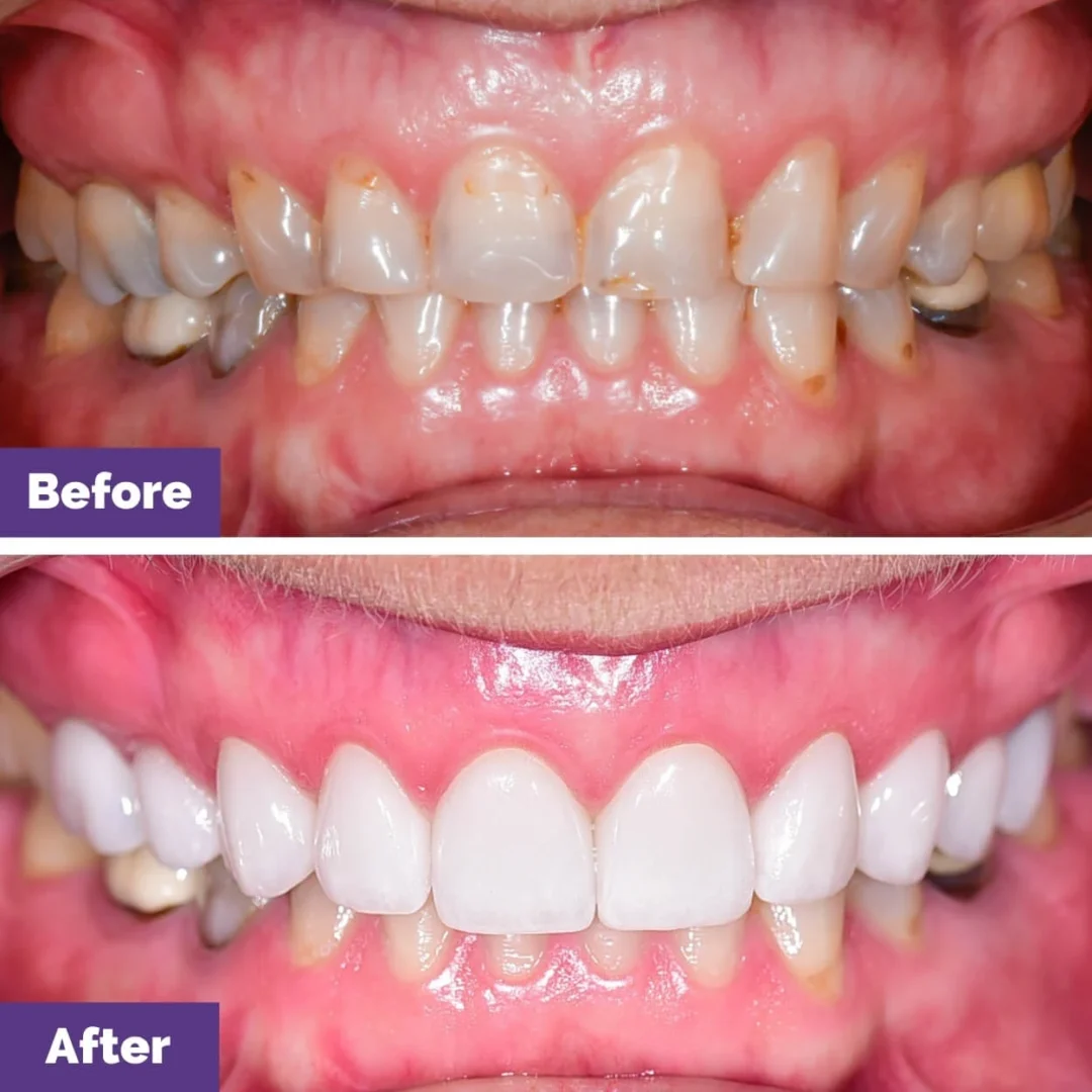Can Porcelain Veneers Address Multiple Aesthetic Concerns in Sunbury