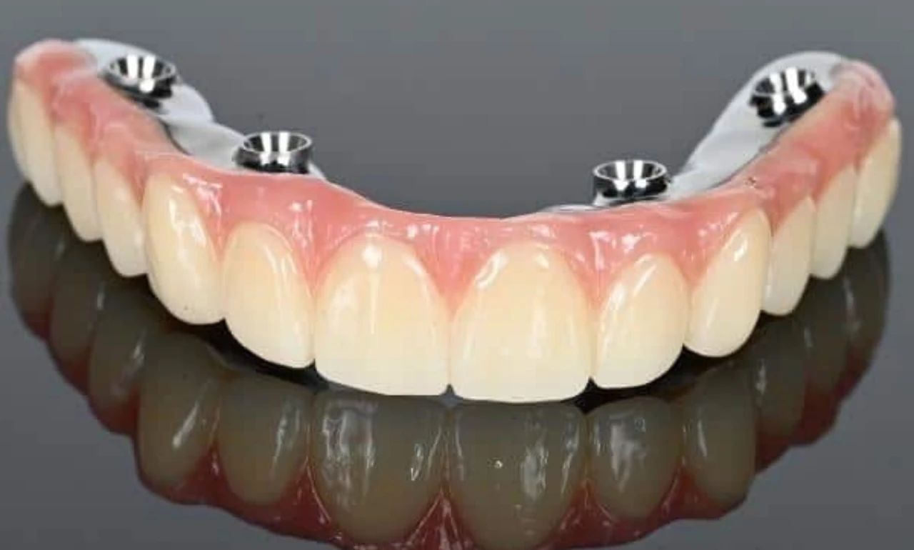 Can You Get Both Upper and Lower AllOn Plus on the Same Day