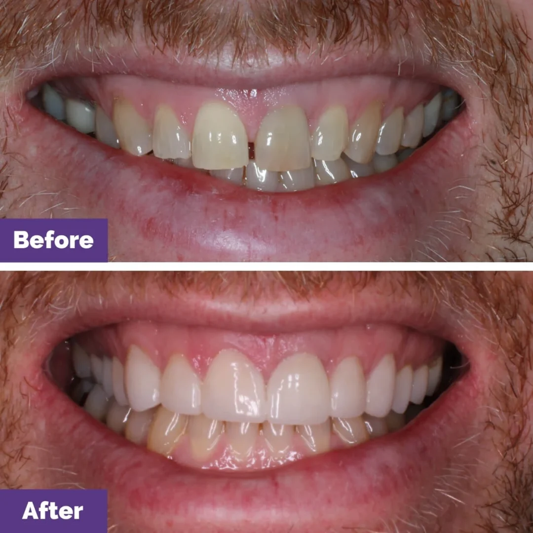 Combined Crowns Veneers Cracked Teeth Case