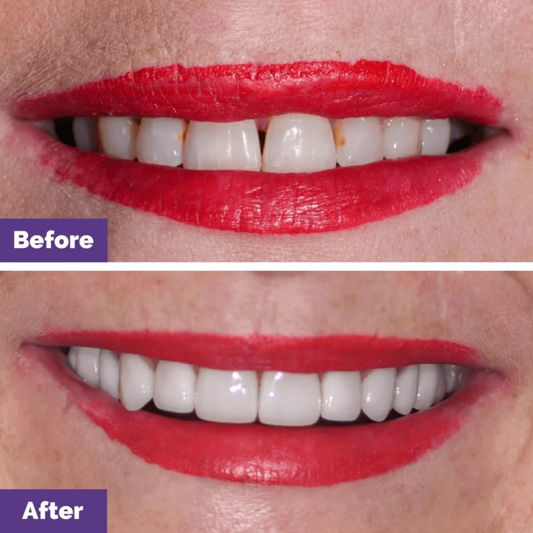 Combined Veneers Implants Case Study