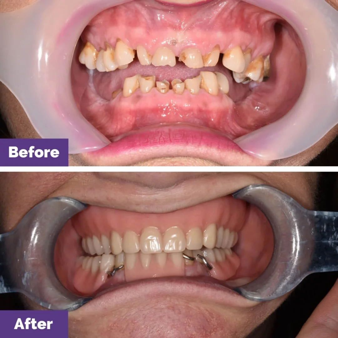 Complete Dentures Case Study