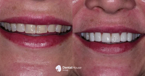 Composite Veneers Whitening Case Study in Sunbury