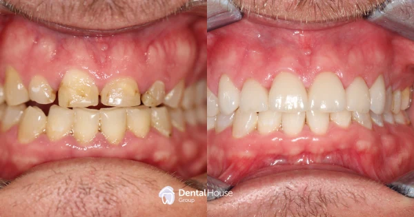 Conservative Crown Restoration Clinical Case in Gisborne