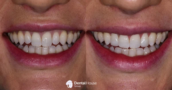 Conservative Dental Treatment Clinical Case in Gisborne